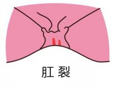 肛裂出血怎么办一拉屎就出血？